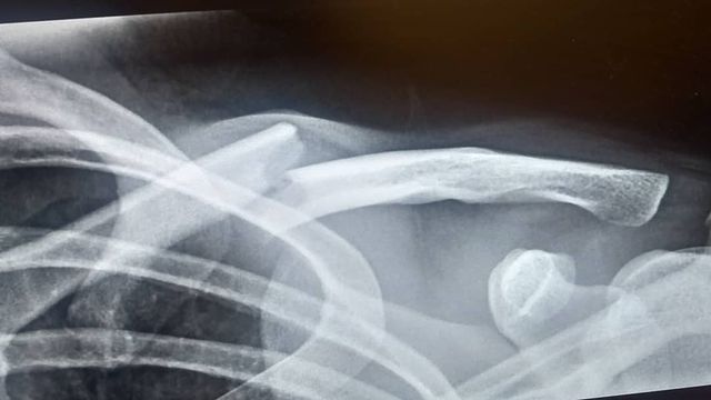 image from Broke my collarbone 😩😭 (with gopro video!)